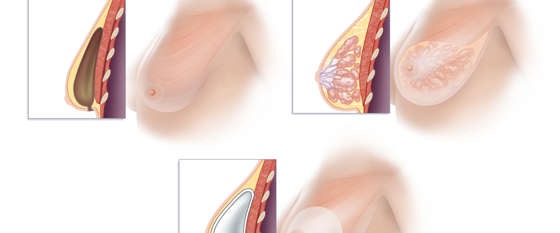Understanding Implant Reconstruction: Everything You Need to Know