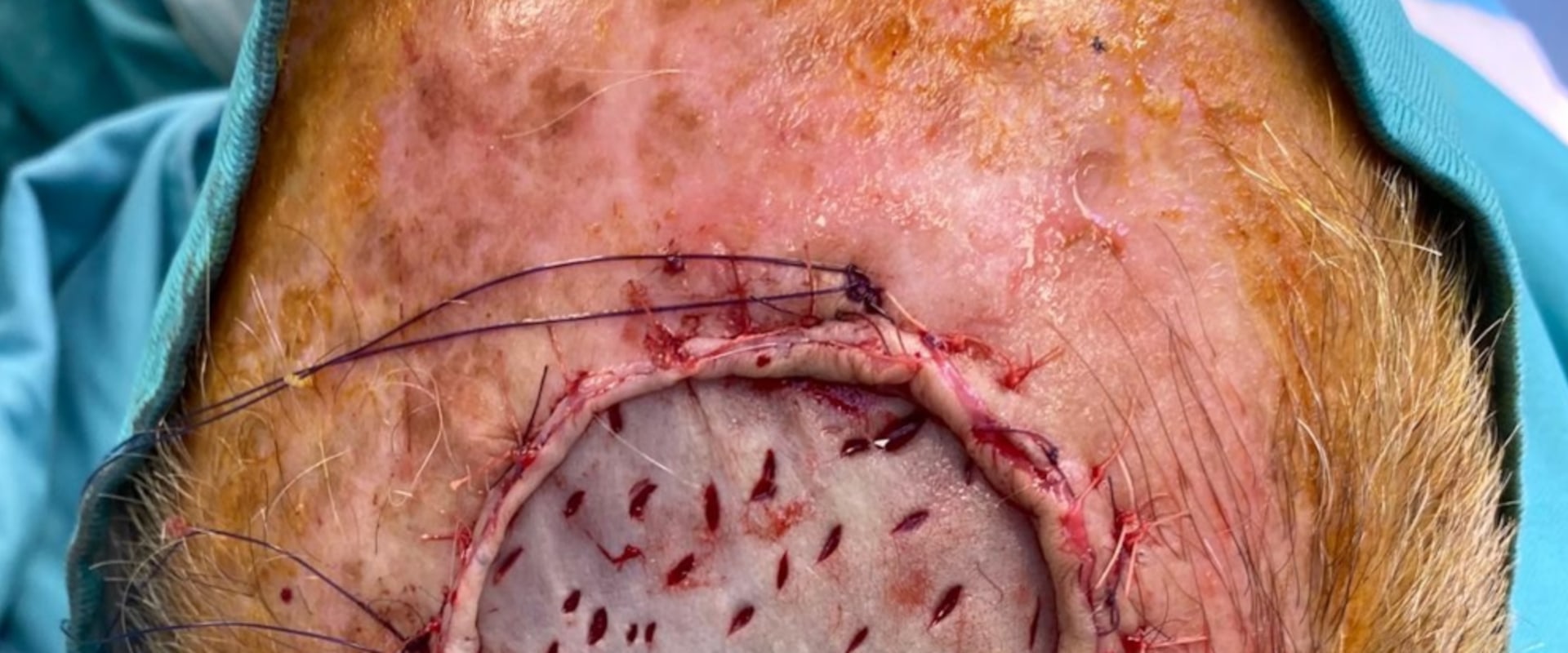 Skin Grafting: A Comprehensive Guide to Reconstructive Surgery Procedures