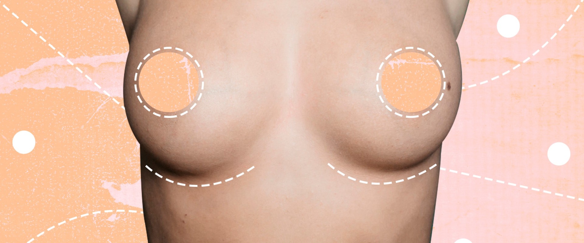 Breast Augmentation: Everything You Need to Know
