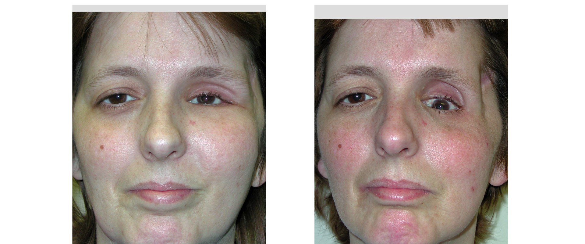 Facial Fracture Repair: Understanding Reconstructive Surgery Procedures