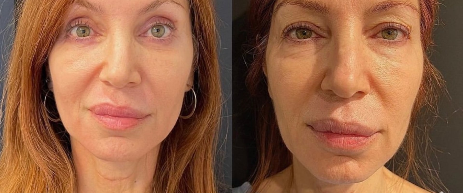 Understanding Blepharoplasty: A Comprehensive Guide to Facial Surgeries