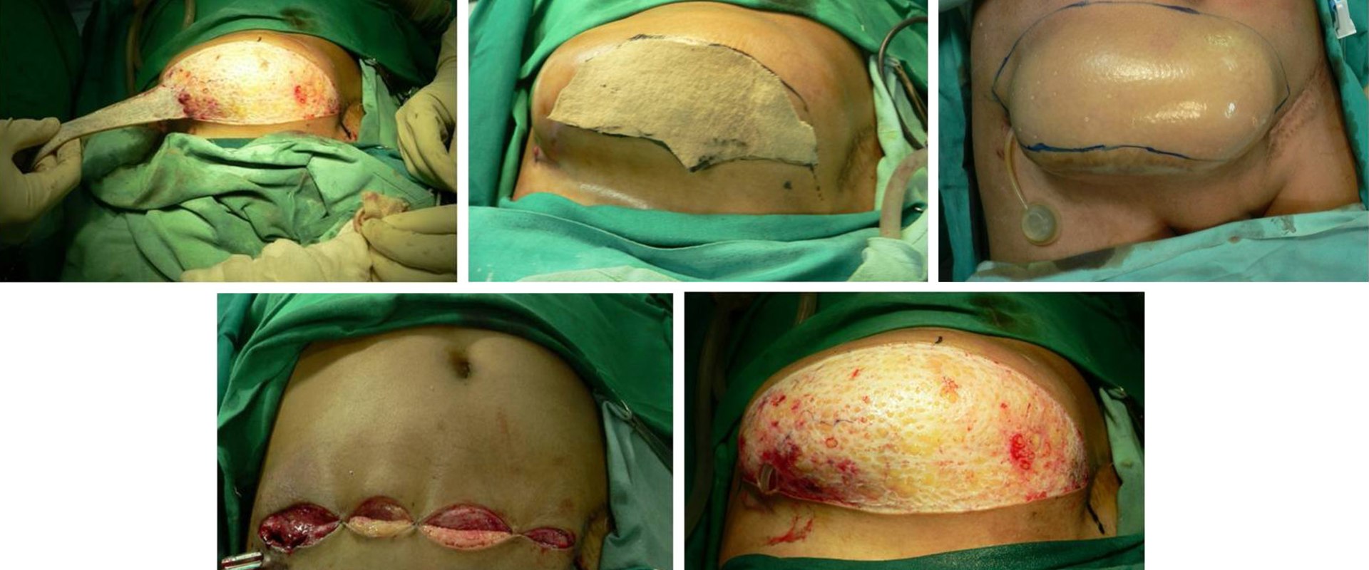 A Comprehensive Look at Tissue Expansion for Reconstructive Surgery Procedures