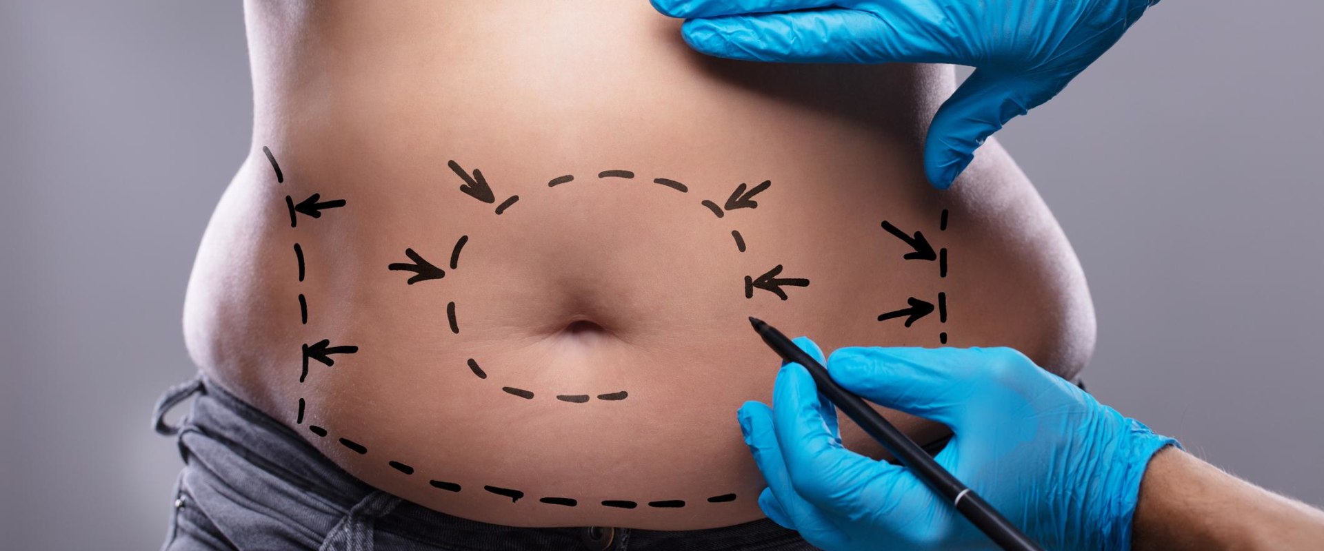 The Ins and Outs of Tummy Tucks: What You Need to Know Before Going Under the Knife