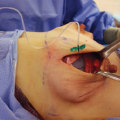 Why are surgeons called plastic surgeons?