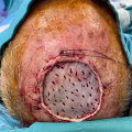 Skin Grafting: A Comprehensive Guide to Reconstructive Surgery Procedures