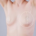 Nipple Reconstruction: Restoring Confidence and Femininity