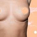 Breast Augmentation: Everything You Need to Know
