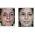 Facial Fracture Repair: Understanding Reconstructive Surgery Procedures