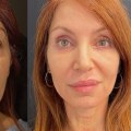 Understanding Blepharoplasty: A Comprehensive Guide to Facial Surgeries