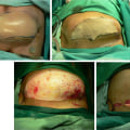 A Comprehensive Look at Tissue Expansion for Reconstructive Surgery Procedures