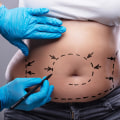 The Ins and Outs of Tummy Tucks: What You Need to Know Before Going Under the Knife