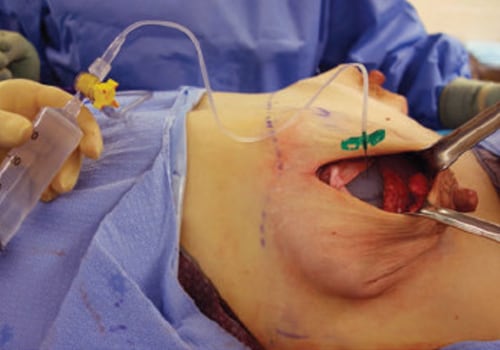 Why are surgeons called plastic surgeons?