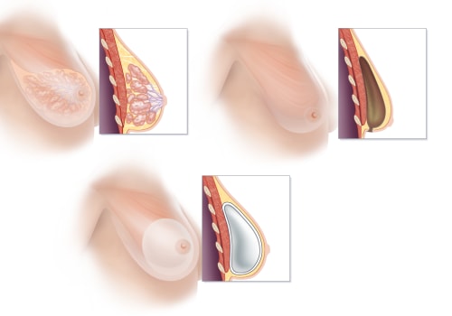 Understanding Implant Reconstruction: Everything You Need to Know