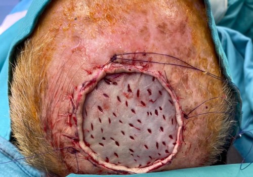 Skin Grafting: A Comprehensive Guide to Reconstructive Surgery Procedures