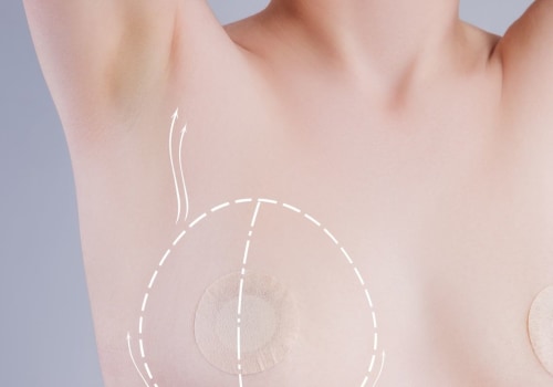Nipple Reconstruction: Restoring Confidence and Femininity
