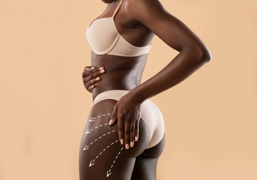 All You Need to Know About Brazilian Butt Lift: Enhance Your Curves with Confidence