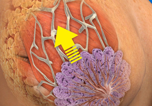 A Comprehensive Look into Breast Lifts: What You Need to Know