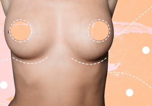 Breast Augmentation: Everything You Need to Know