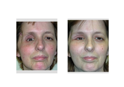 Facial Fracture Repair: Understanding Reconstructive Surgery Procedures