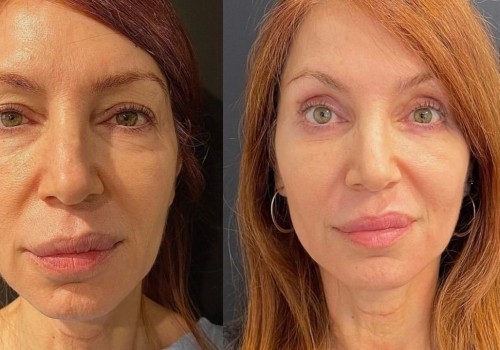 Understanding Blepharoplasty: A Comprehensive Guide to Facial Surgeries