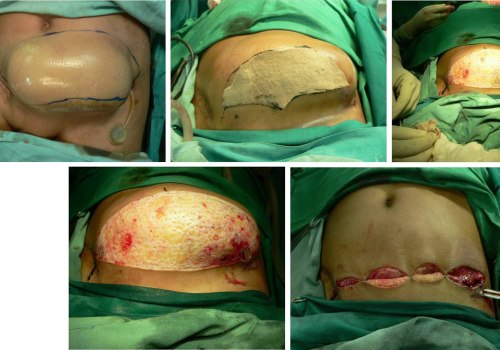 A Comprehensive Look at Tissue Expansion for Reconstructive Surgery Procedures