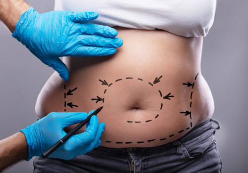 The Ins and Outs of Tummy Tucks: What You Need to Know Before Going Under the Knife